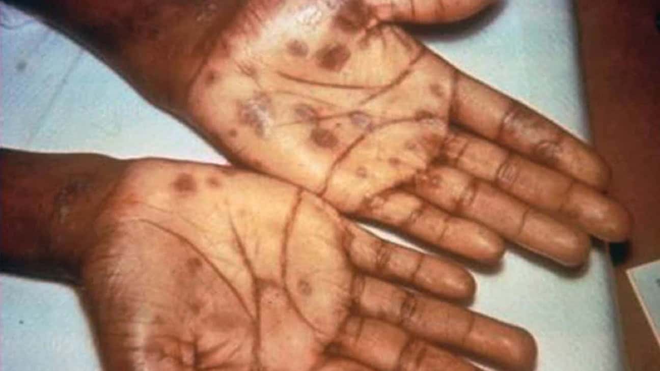 Secondary stage syphilis sores (lesions) on the palms of the hands.